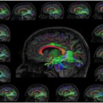 Visualization of the left Inferior Longitudinal Fasciculus (ILF) in Morse code learners, showing white matter tracts in the brain.