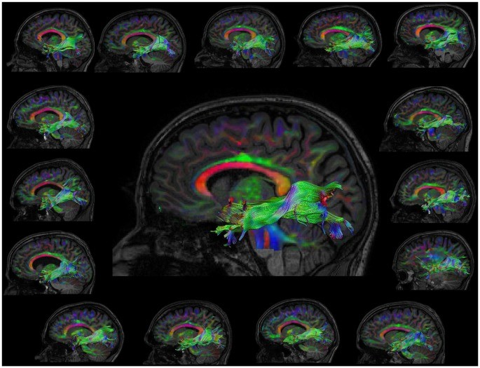 Visualization of the left Inferior Longitudinal Fasciculus (ILF) in Morse code learners, showing white matter tracts in the brain.