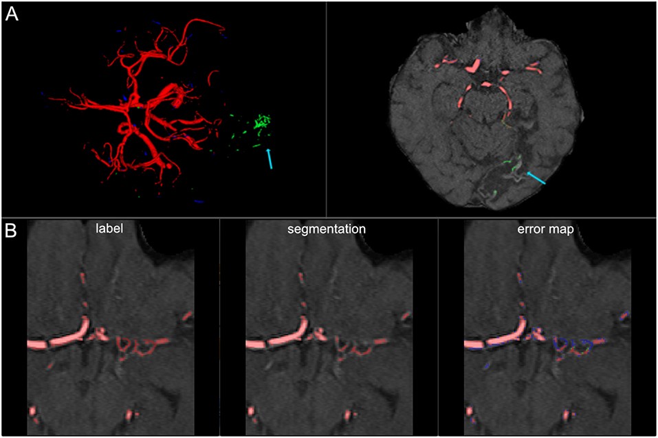 False Labeling of Specific Cerebrovascular Pathologies