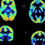 Brain scans showing differences in activity between a psychopath's brain and a normal brain