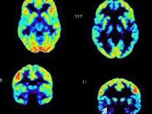 Brain scans showing differences in activity between a psychopath's brain and a normal brain