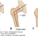 Hip structure variations: Coxa vara can limit range of motion for splits, while Coxa valga may offer an advantage