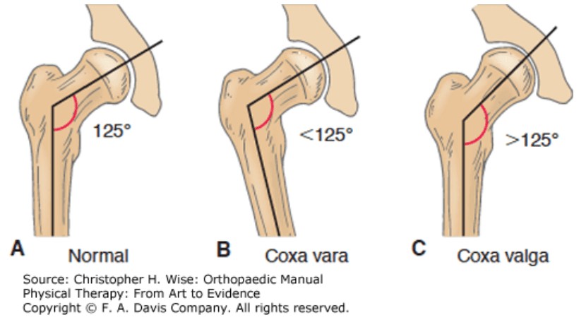 Hip structure variations: Coxa vara can limit range of motion for splits, while Coxa valga may offer an advantage