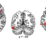 Deaf Readers Brain Activation